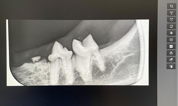 Digitales Dentalröntgen, Bild 1