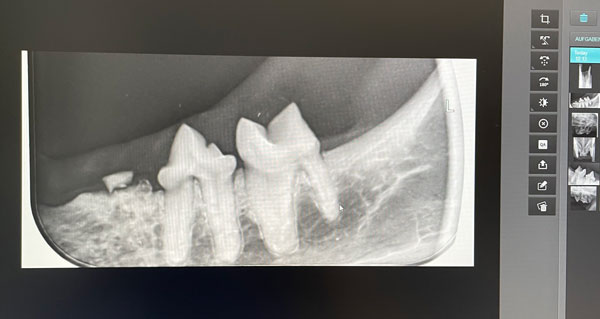 Digitales Röntgen Zähne, Bild 1